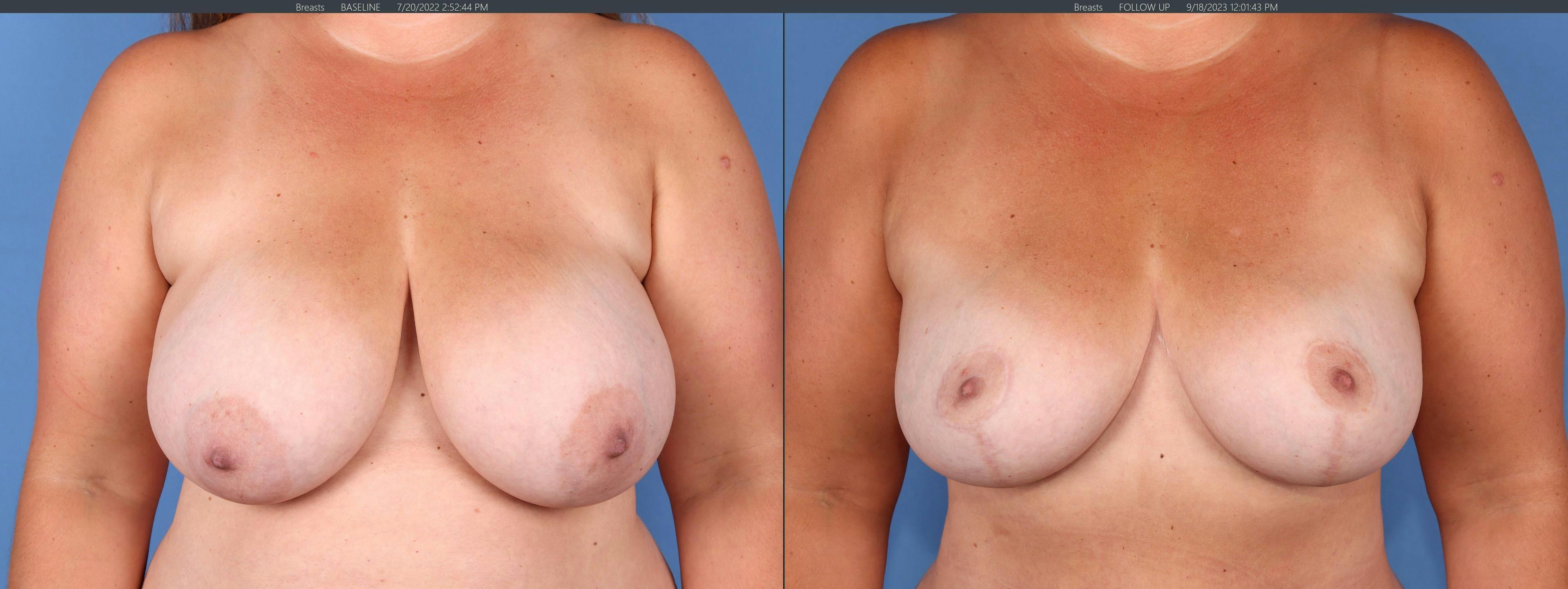 Breast Lift Before & After Gallery - Patient 176985859 - Image 1