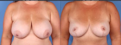 Breast Lift Before & After Gallery - Patient 176985859 - Image 1