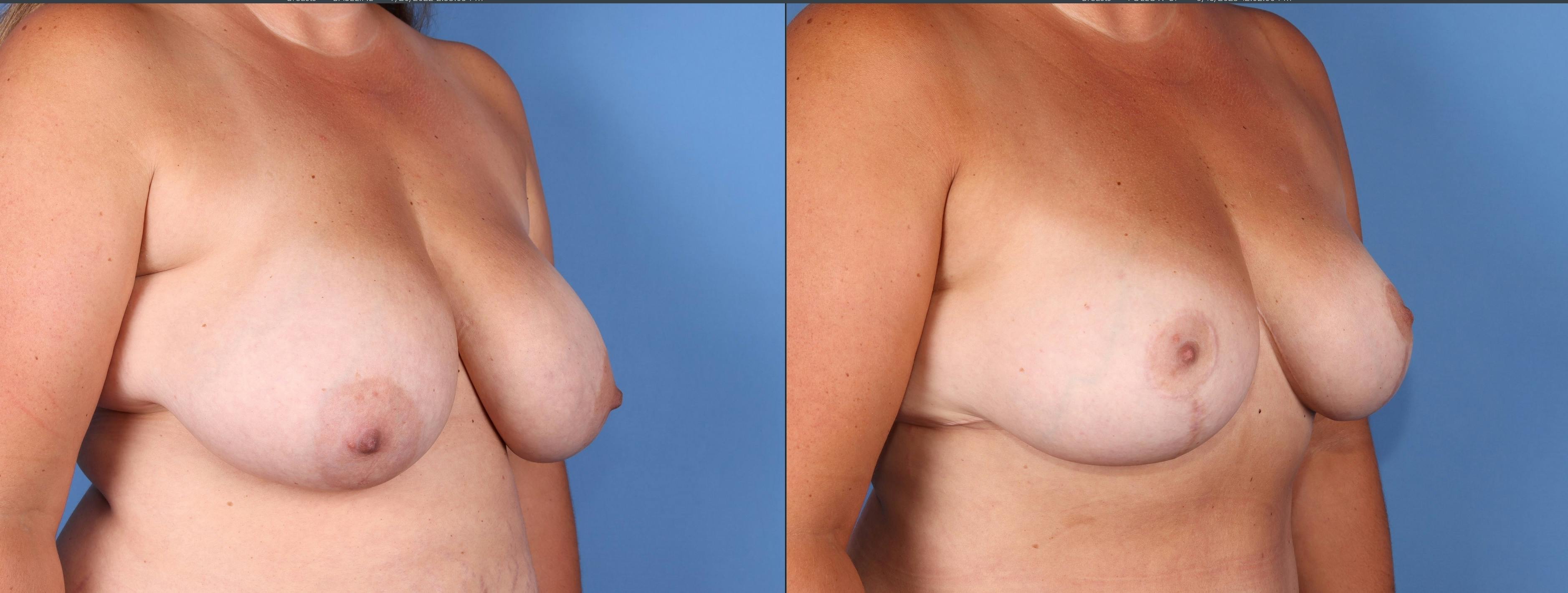 Breast Lift Before & After Gallery - Patient 176985859 - Image 2