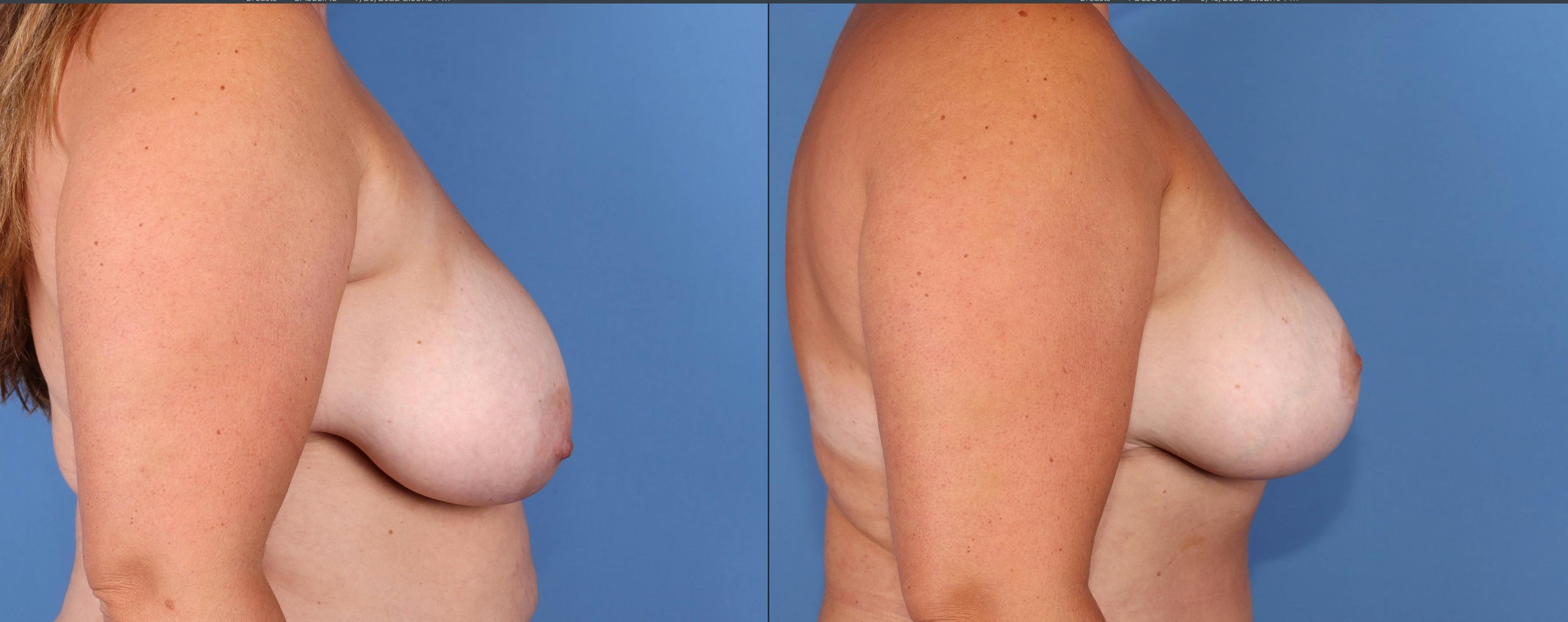Breast Lift Before & After Gallery - Patient 176985859 - Image 3