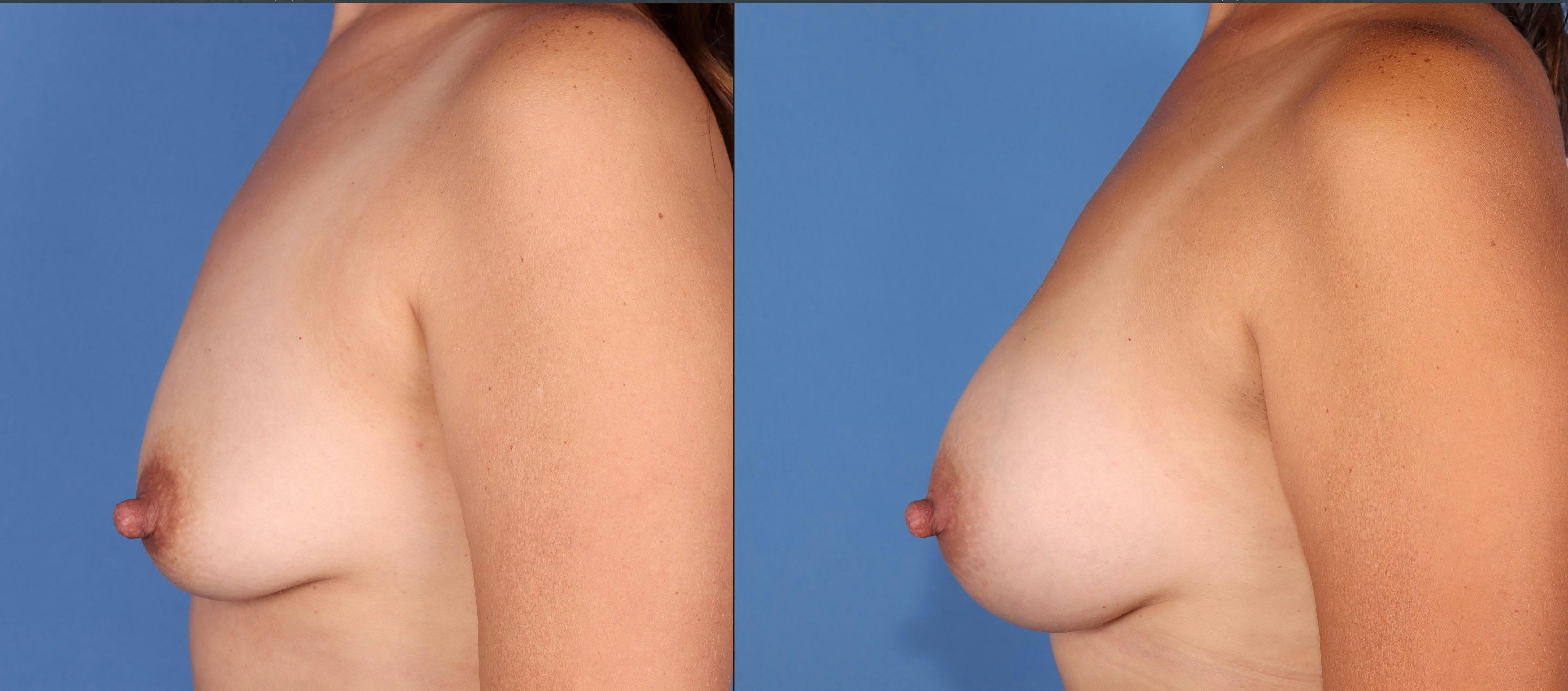 Breast Augmentation Before & After Gallery - Patient 176985874 - Image 3