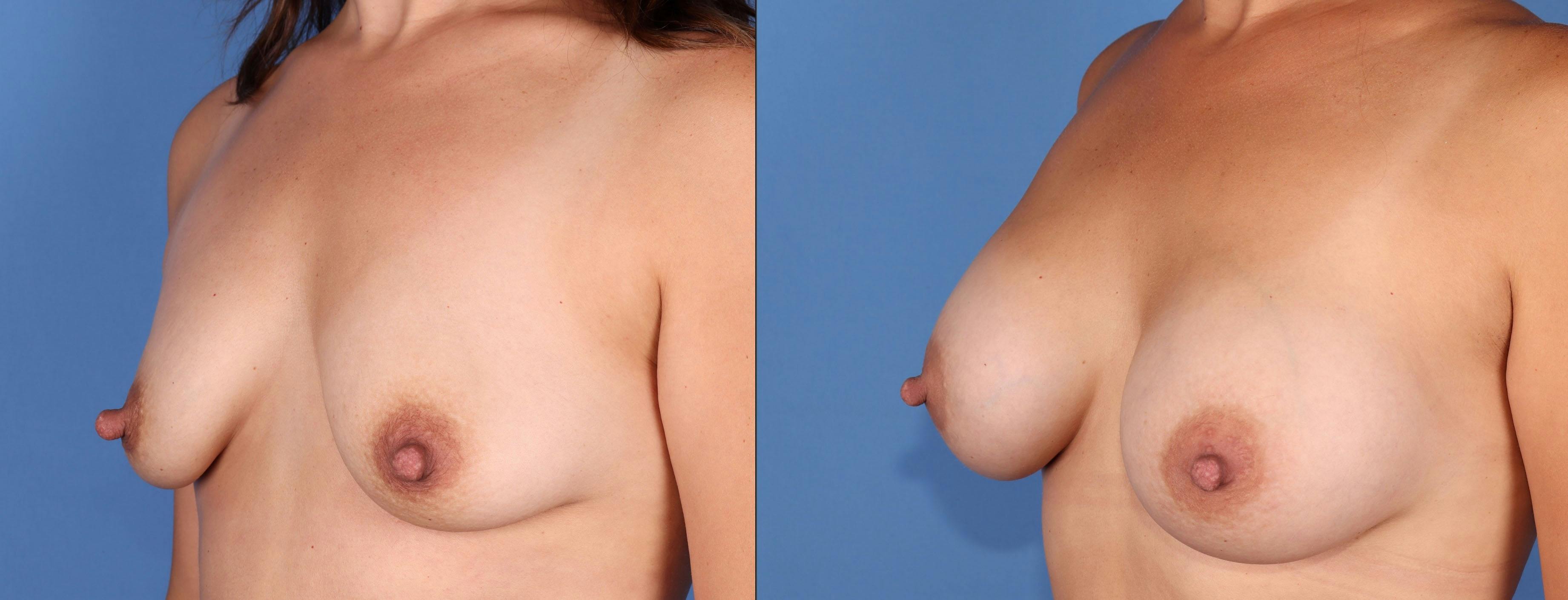 Breast Augmentation Before & After Gallery - Patient 176985874 - Image 2