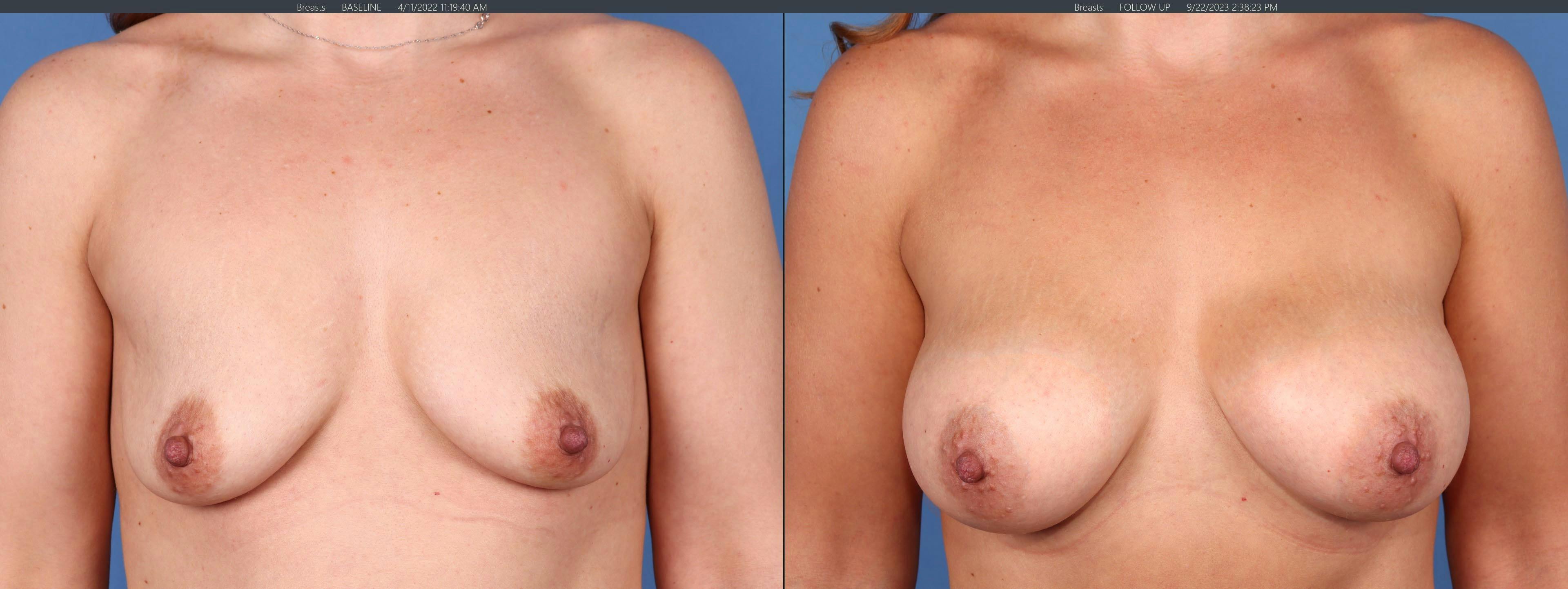 Breast Augmentation Before & After Gallery - Patient 179380924 - Image 1