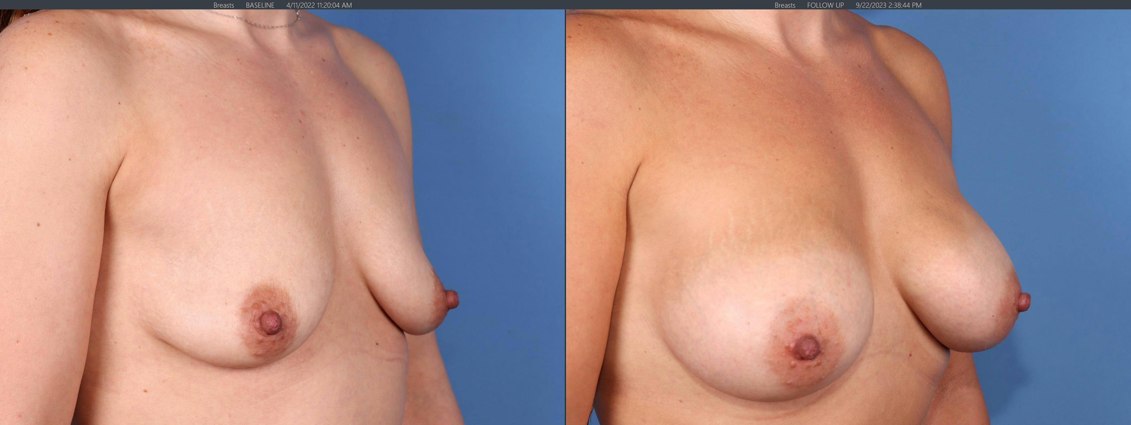 Breast Augmentation Before & After Gallery - Patient 179380924 - Image 2