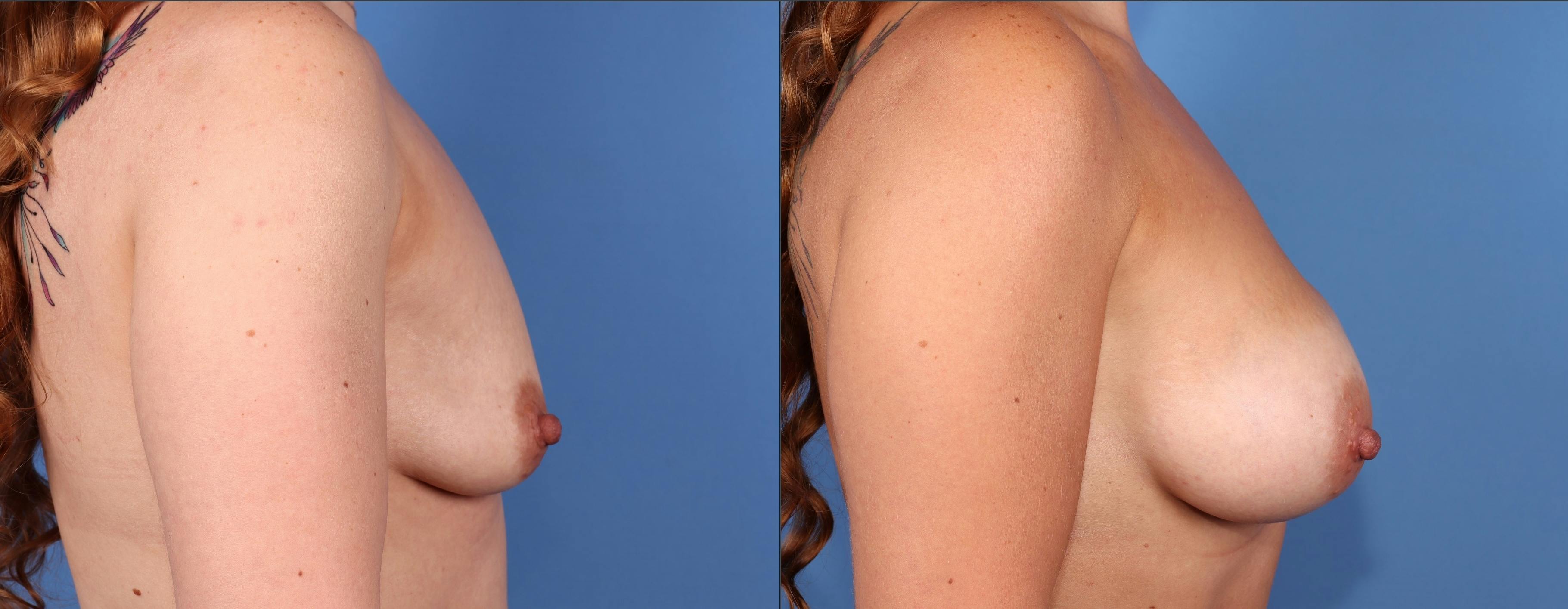 Breast Augmentation Before & After Gallery - Patient 179380924 - Image 3