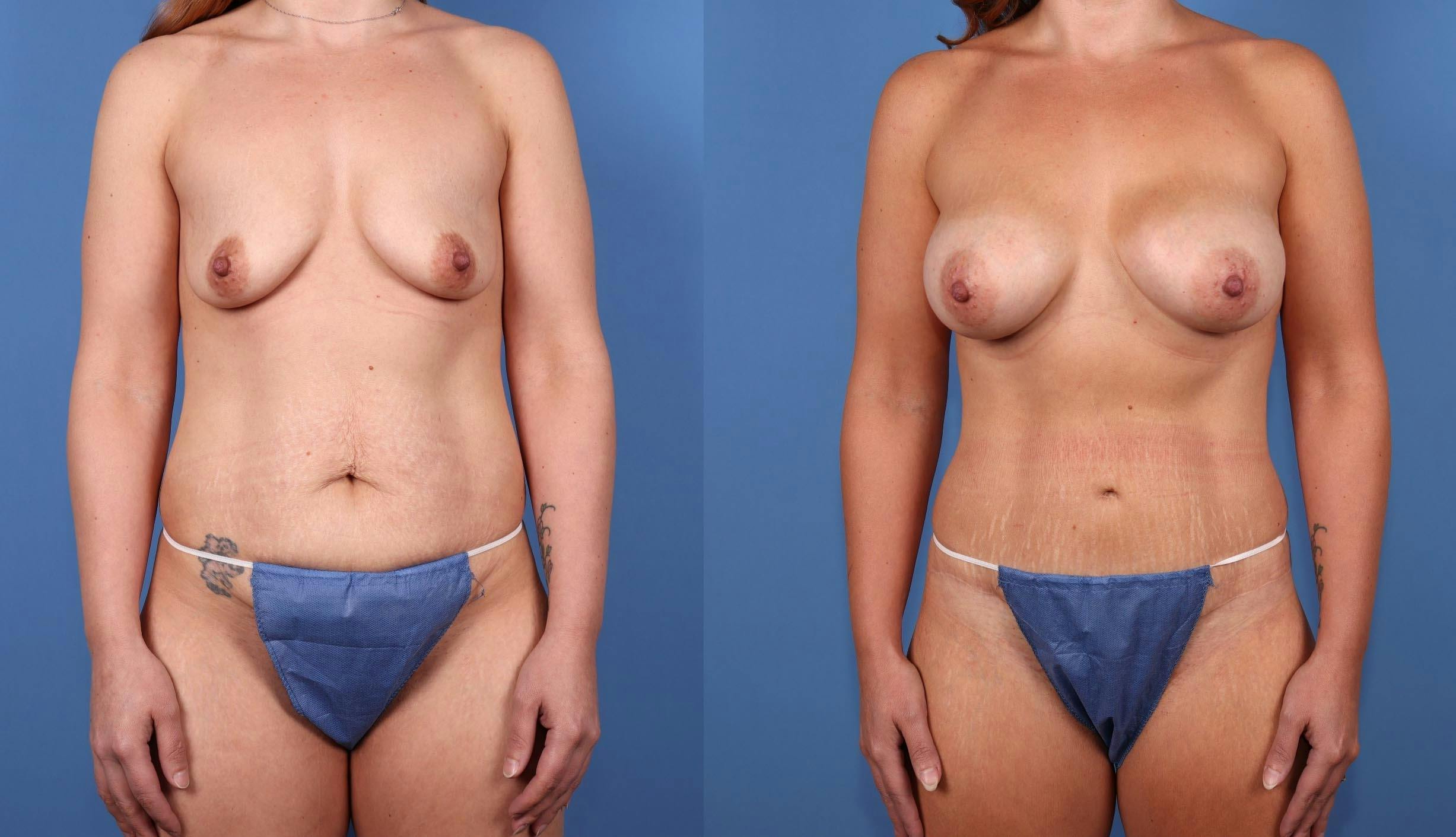 Mommy Makeover Before & After Gallery - Patient 179381294 - Image 1