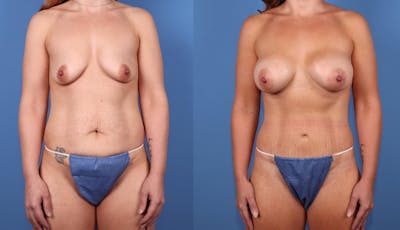 Mommy Makeover Before & After Gallery - Patient 179381294 - Image 1