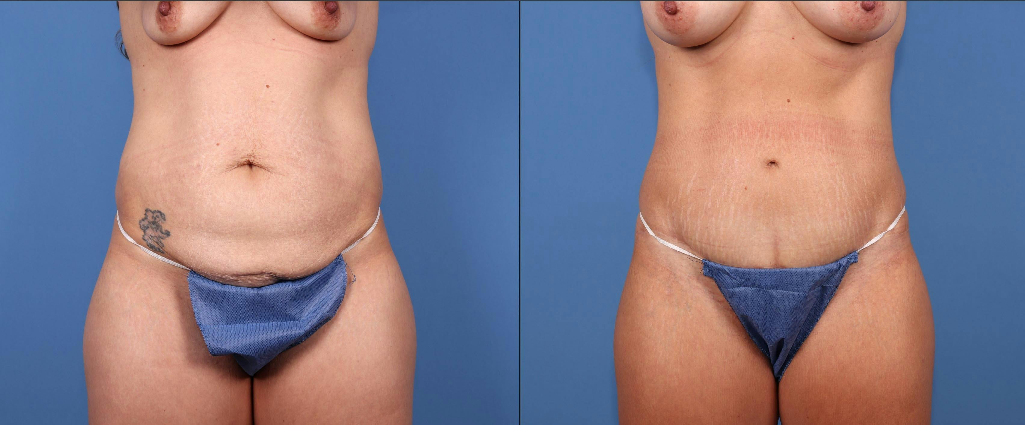 Tummy Tuck Before & After Gallery - Patient 179381190 - Image 1