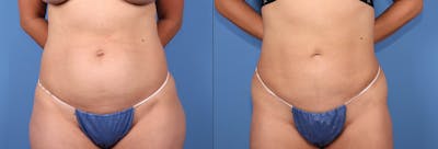 Abdomen Before & After Gallery - Patient 188315723 - Image 1