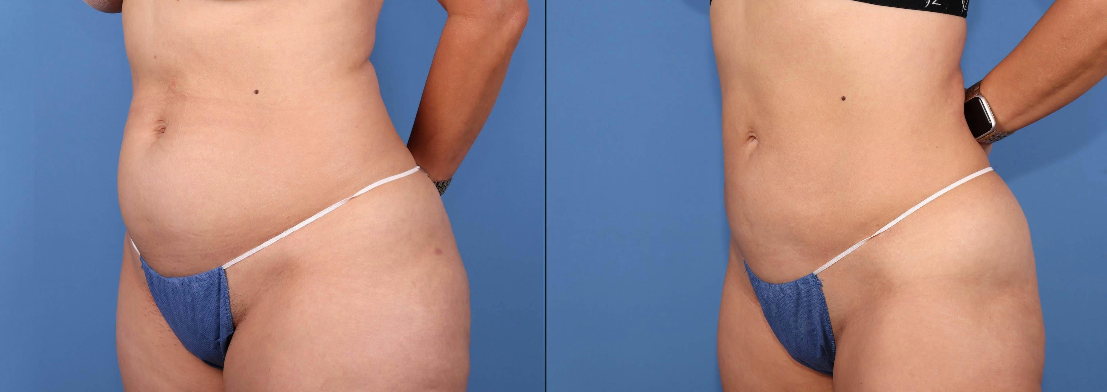 Abdomen Before & After Gallery - Patient 188315723 - Image 2