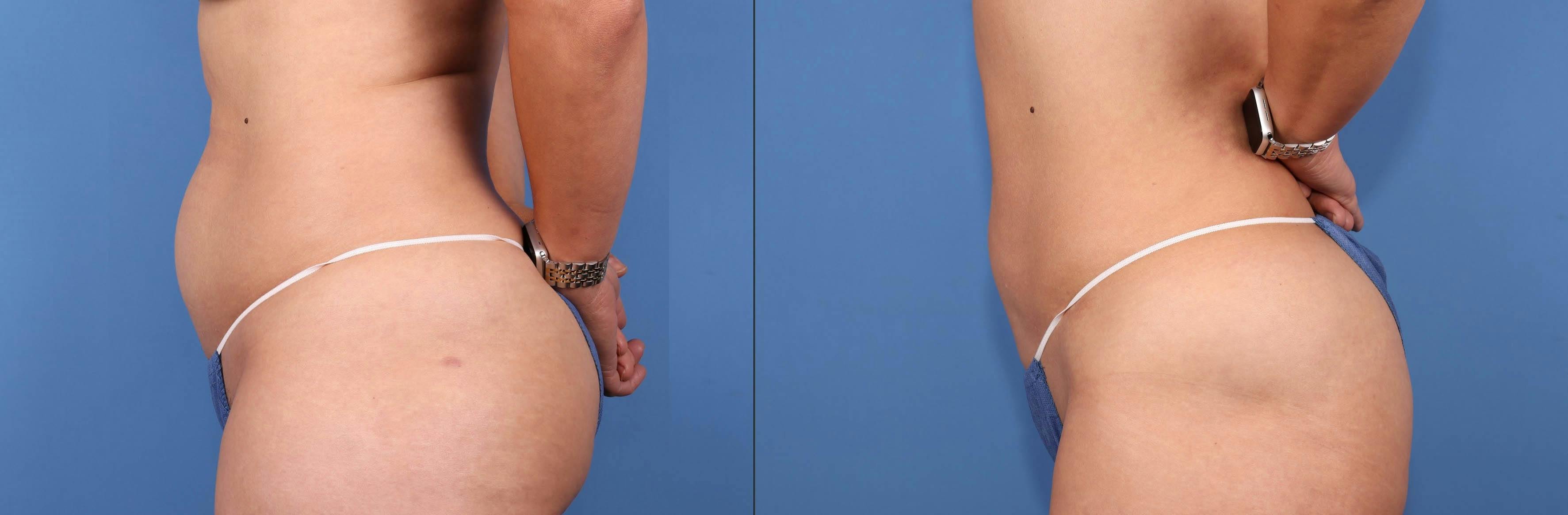 Abdomen Before & After Gallery - Patient 188315723 - Image 3