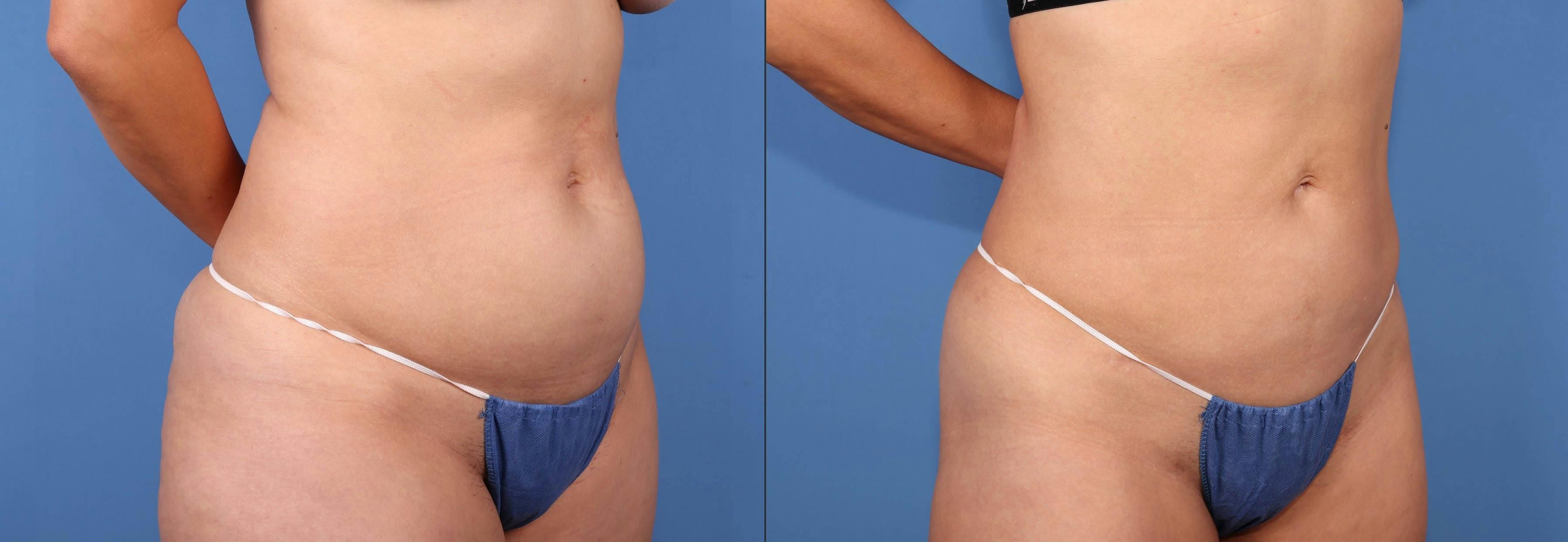 Abdomen Before & After Gallery - Patient 188315723 - Image 4