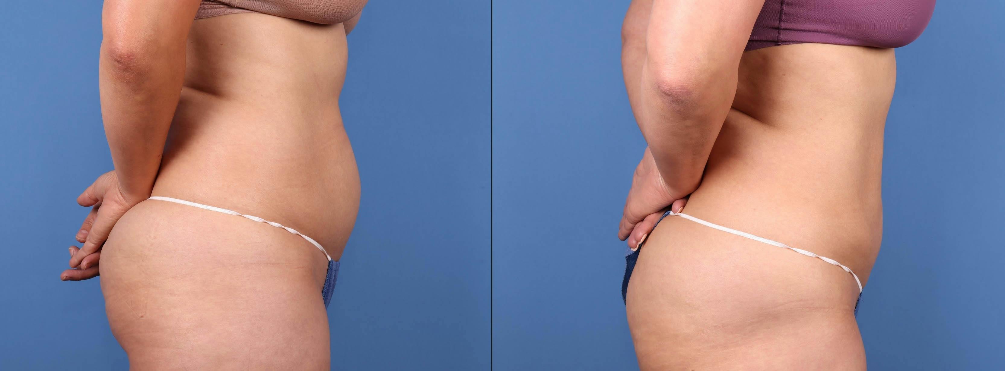 Abdomen Before & After Gallery - Patient 188315723 - Image 6