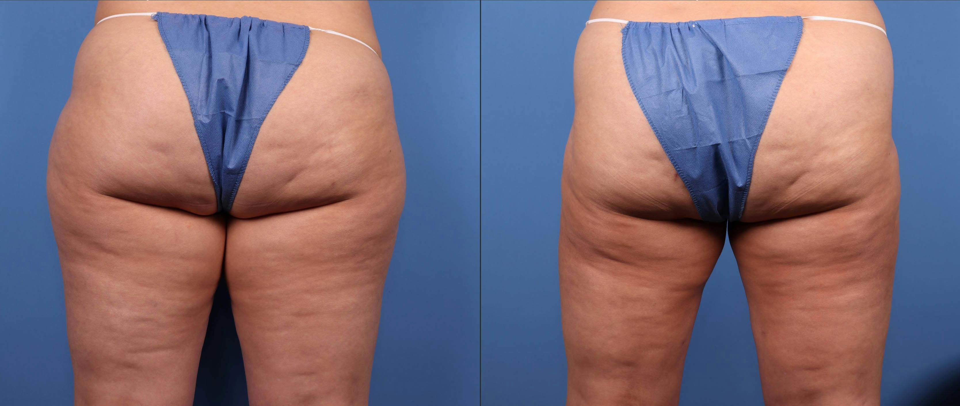 Thighs Before & After Gallery - Patient 188316223 - Image 4