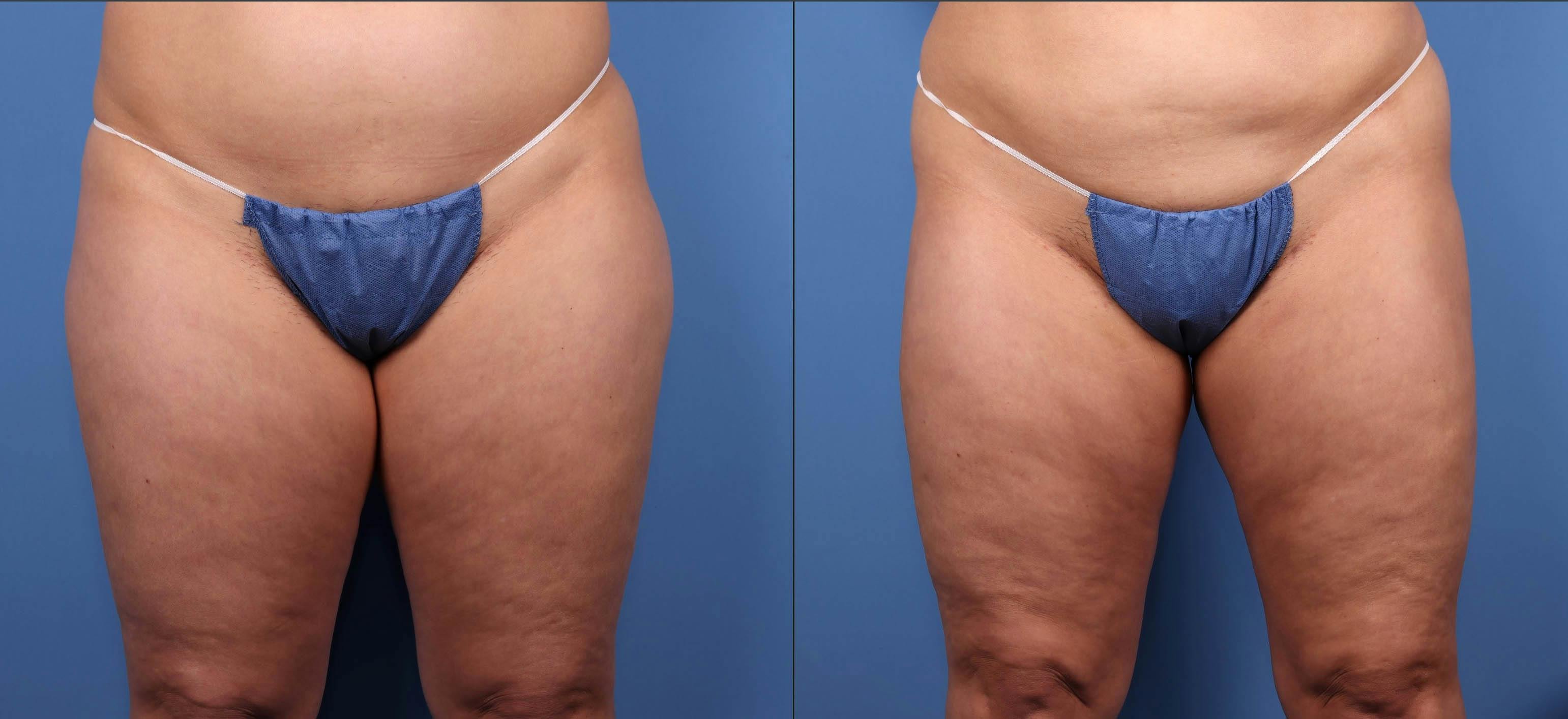 Thighs Before & After Gallery - Patient 188316223 - Image 1