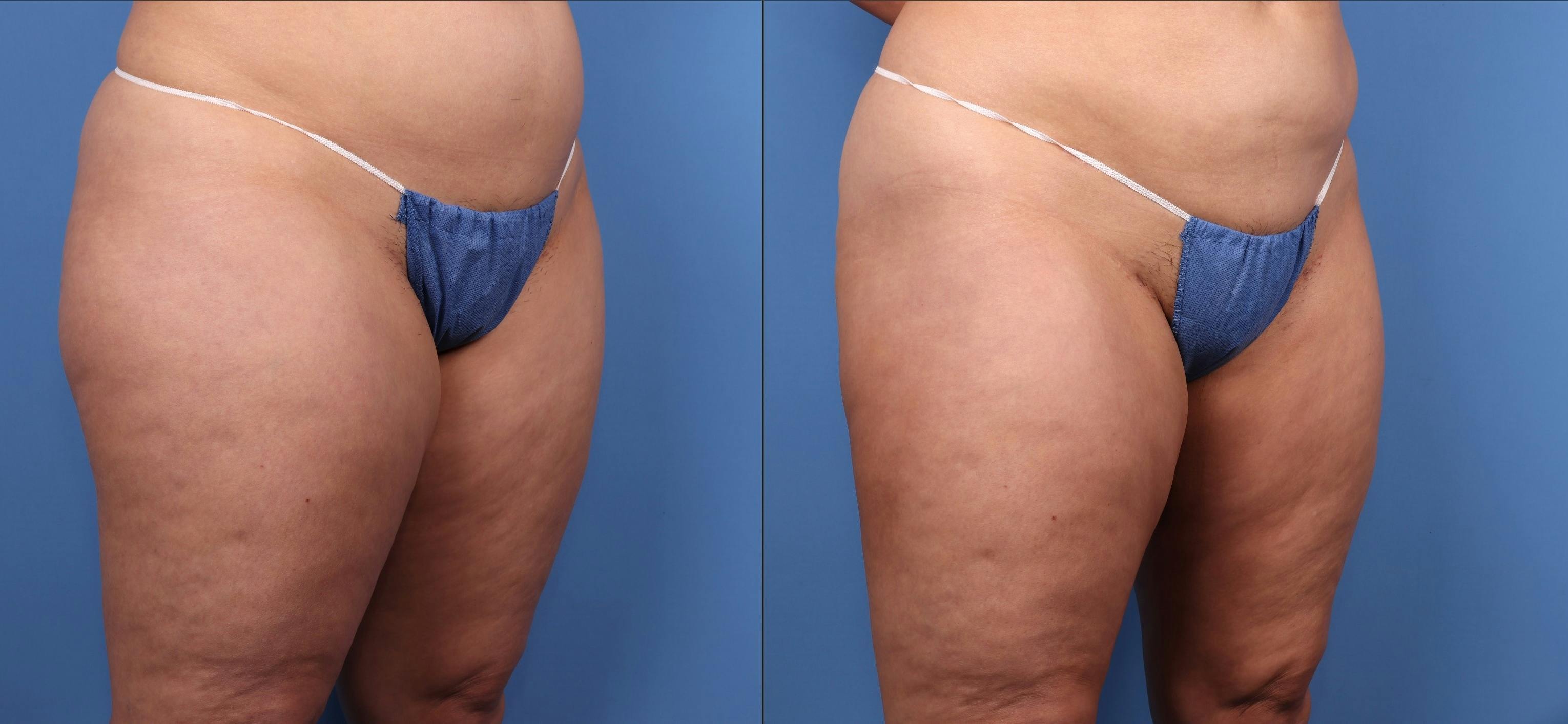 Thighs Before & After Gallery - Patient 188316223 - Image 2