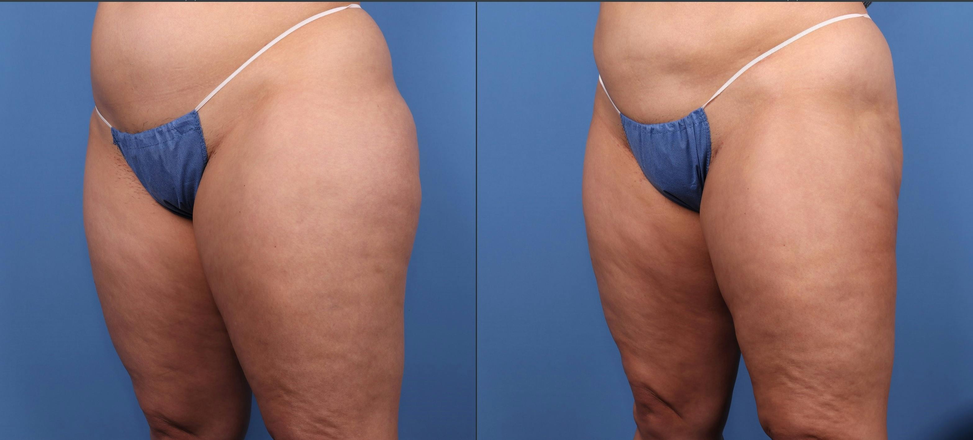Thighs Before & After Gallery - Patient 188316223 - Image 3