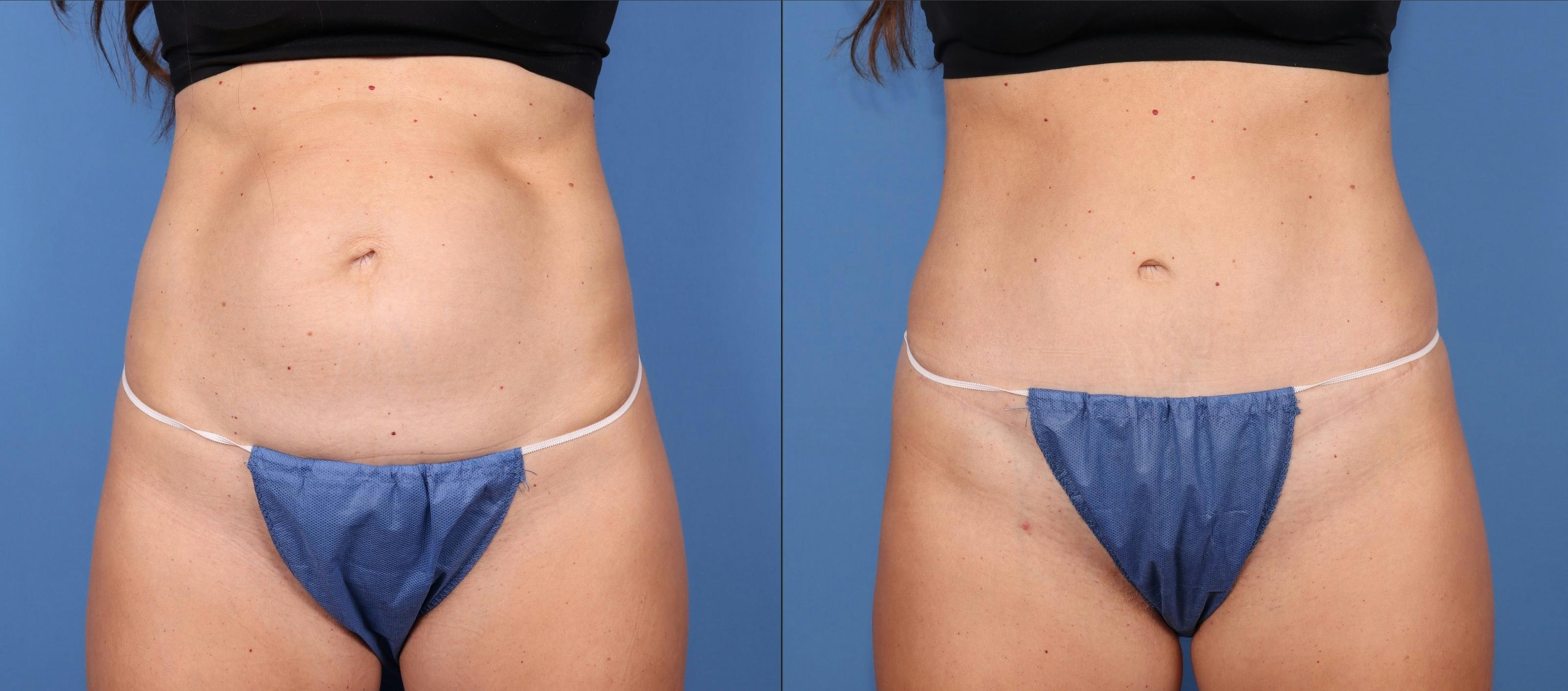 Tummy Tuck Before & After Gallery - Patient 189384535 - Image 1