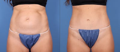 Tummy Tuck Before & After Gallery - Patient 189384535 - Image 1
