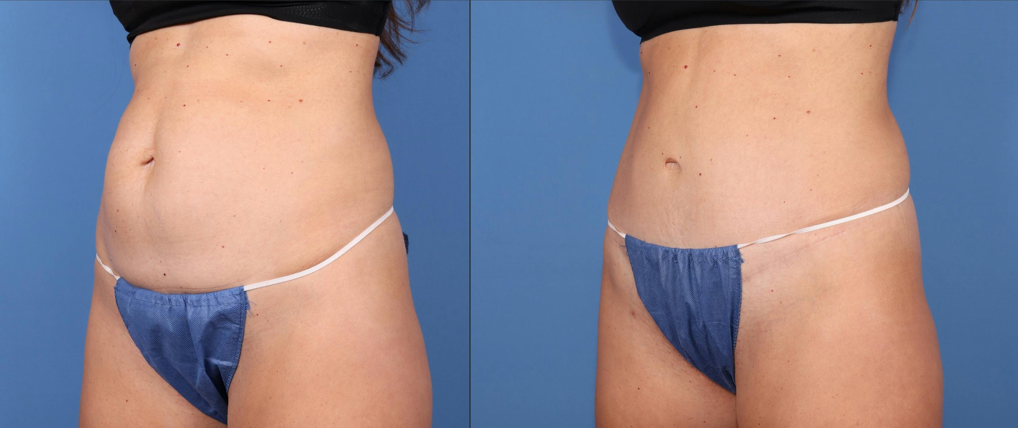 Tummy Tuck Before & After Gallery - Patient 189384535 - Image 2