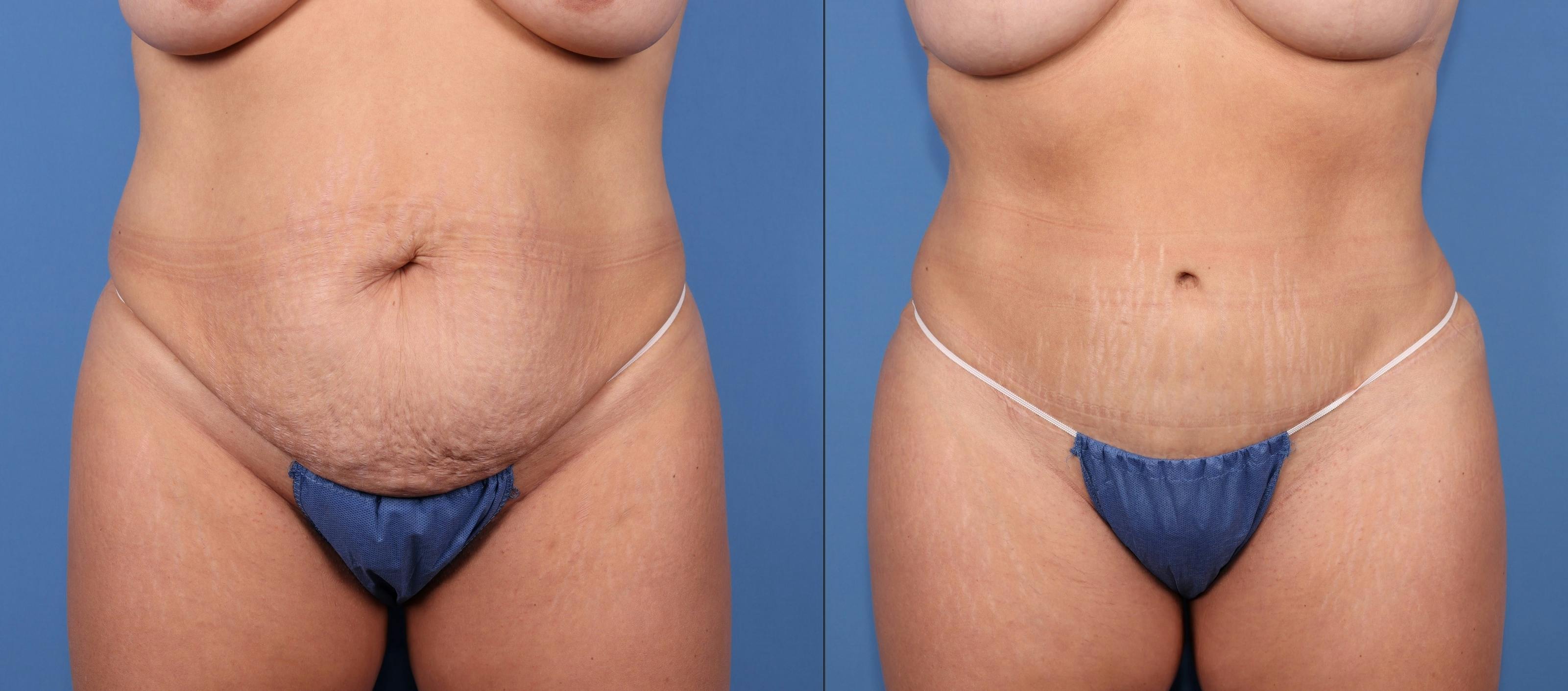 Tummy Tuck Before & After Gallery - Patient 189384658 - Image 1