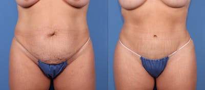 Tummy Tuck Before & After Gallery - Patient 189384658 - Image 1