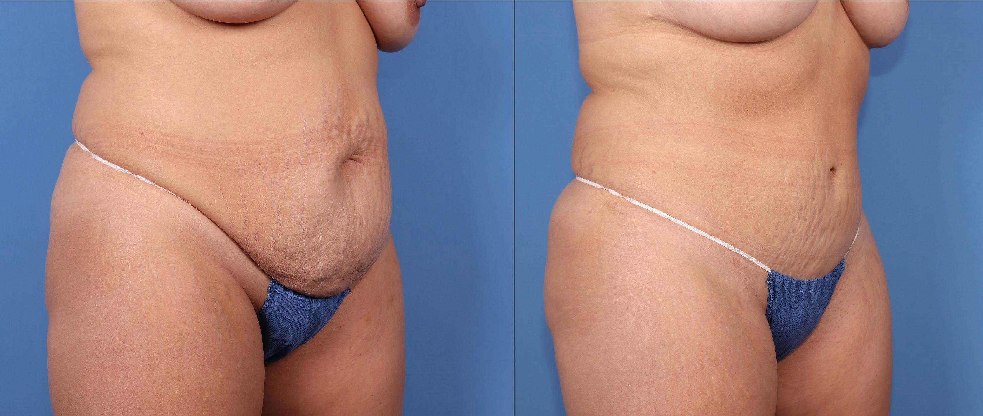 Tummy Tuck Before & After Gallery - Patient 189384658 - Image 2