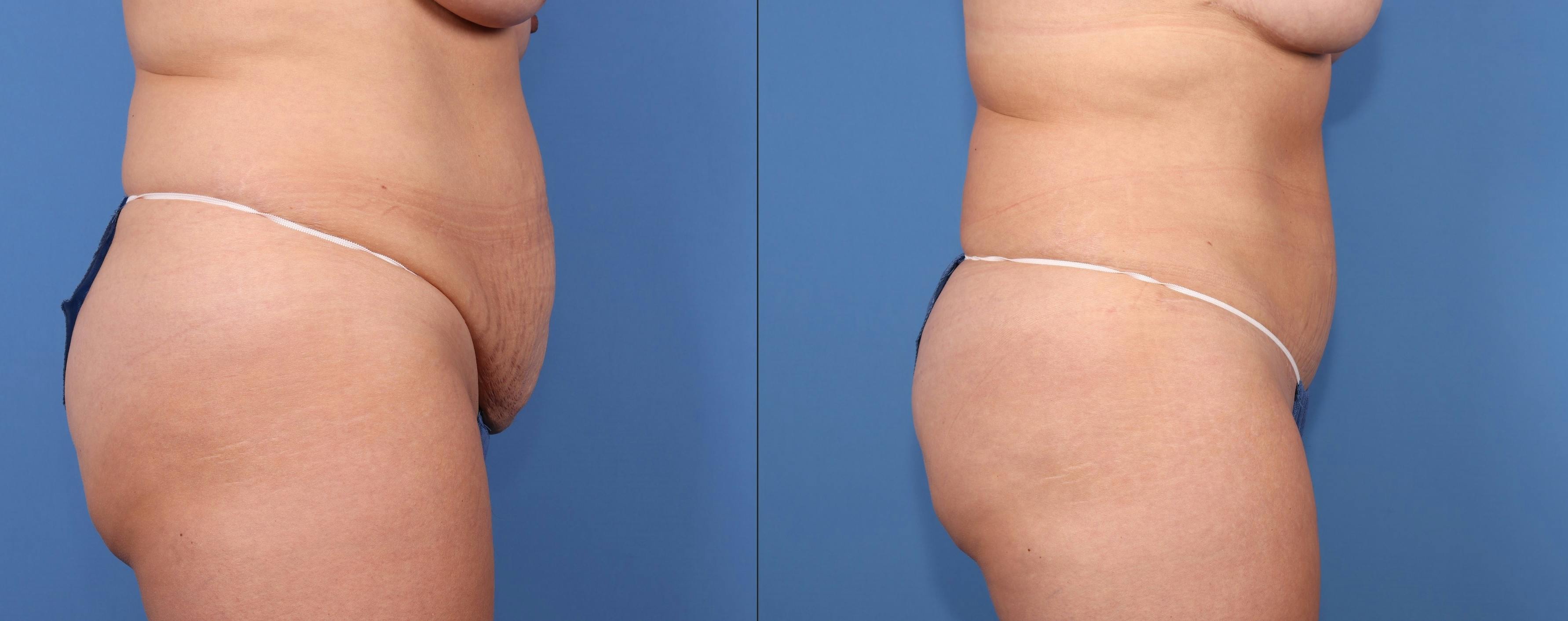 Abdomen Before & After Gallery - Patient 189384664 - Image 3