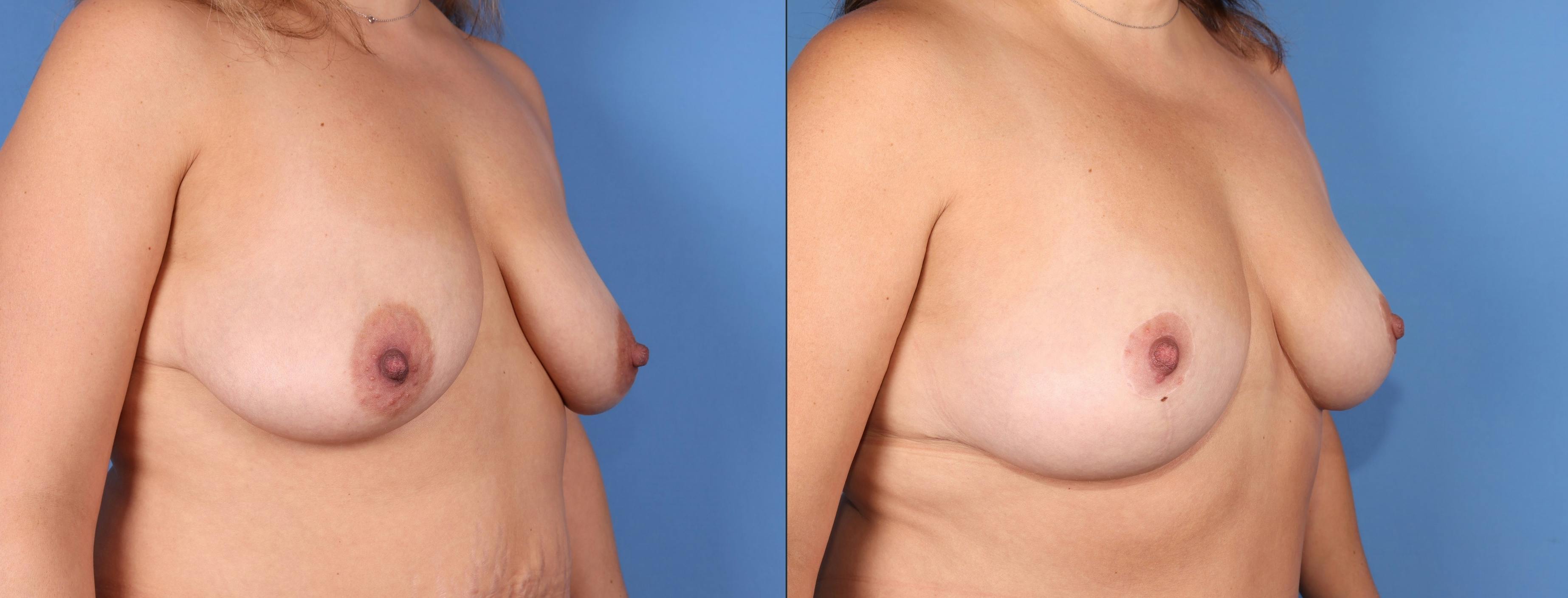 Breast Lift Before & After Gallery - Patient 189384790 - Image 2