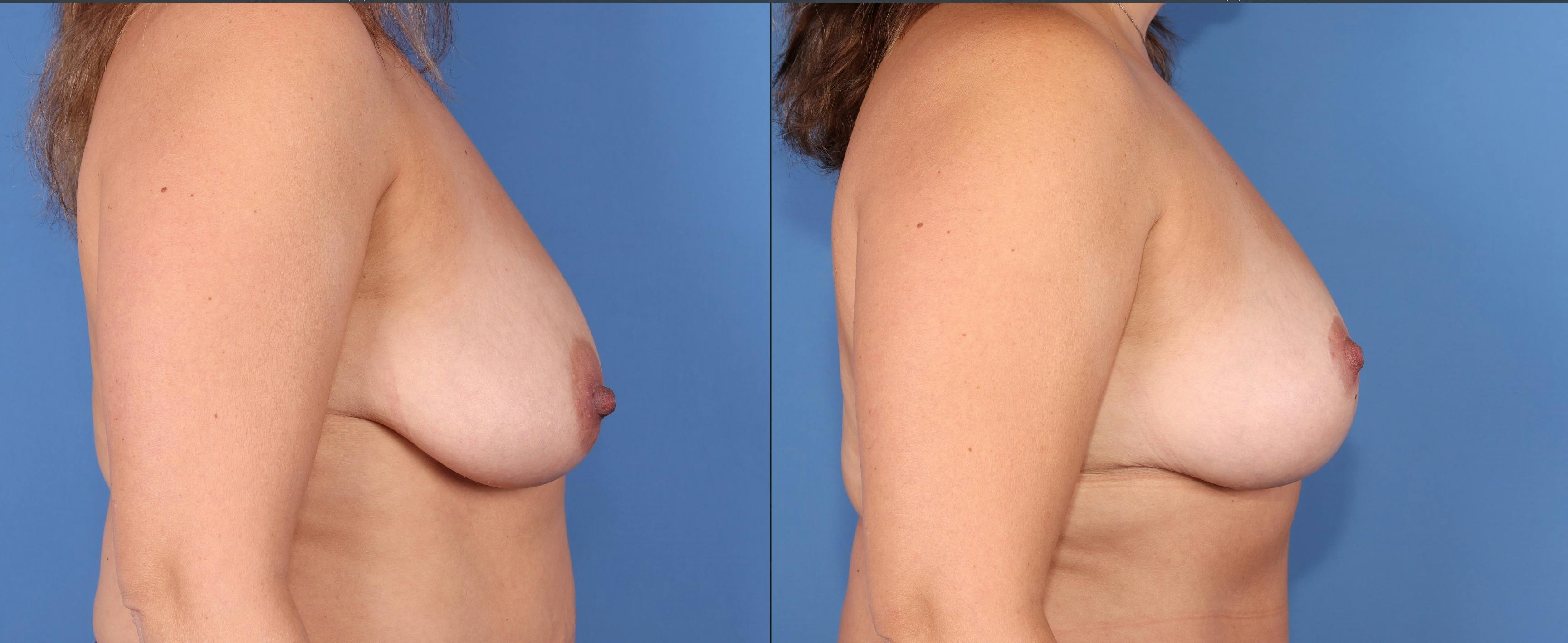 Breast Lift Before & After Gallery - Patient 189384790 - Image 3