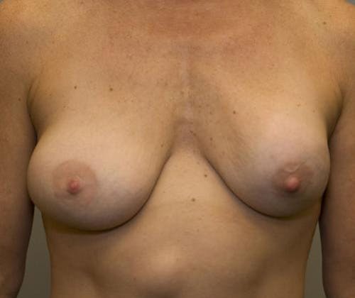 Breast Revision Before & After Gallery - Patient 58179116 - Image 1