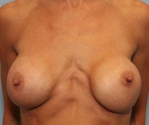 Breast Revision Before & After Gallery - Patient 58179119 - Image 1