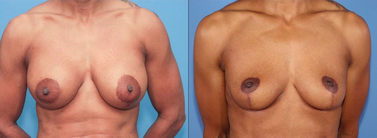 Breast Implant Removal Before & After Gallery - Patient 283538 - Image 1