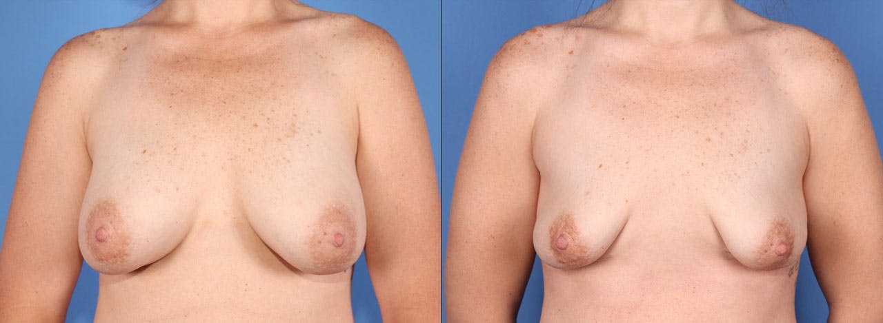 Breast Implant Removal Before & After Gallery - Patient 346506 - Image 1