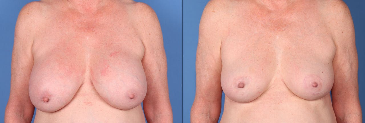 Breast Implant Removal Before & After Gallery - Patient 286450 - Image 1