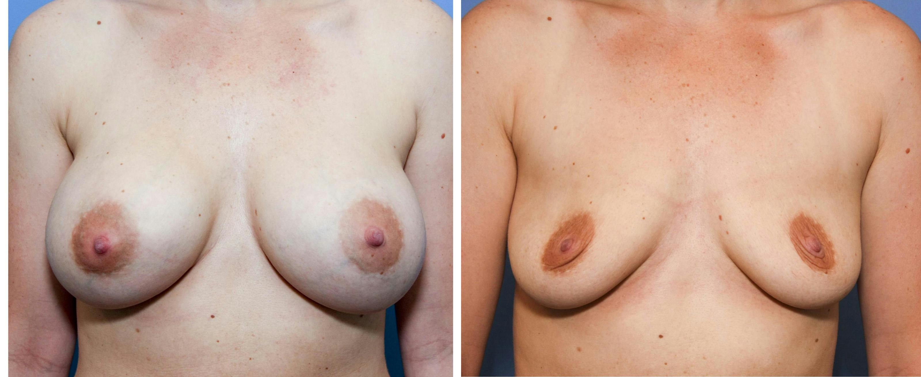 Breast Implant Removal Before & After Gallery - Patient 179961 - Image 1