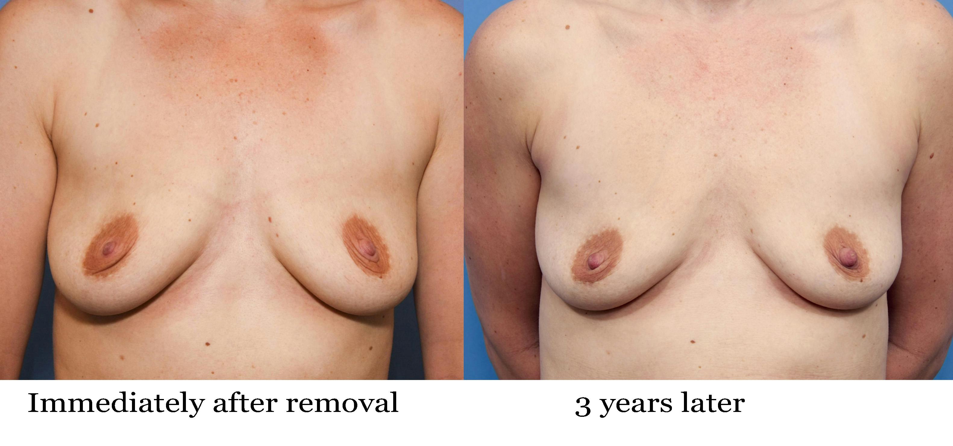 Breast Implant Removal Before & After Gallery - Patient 179961 - Image 2
