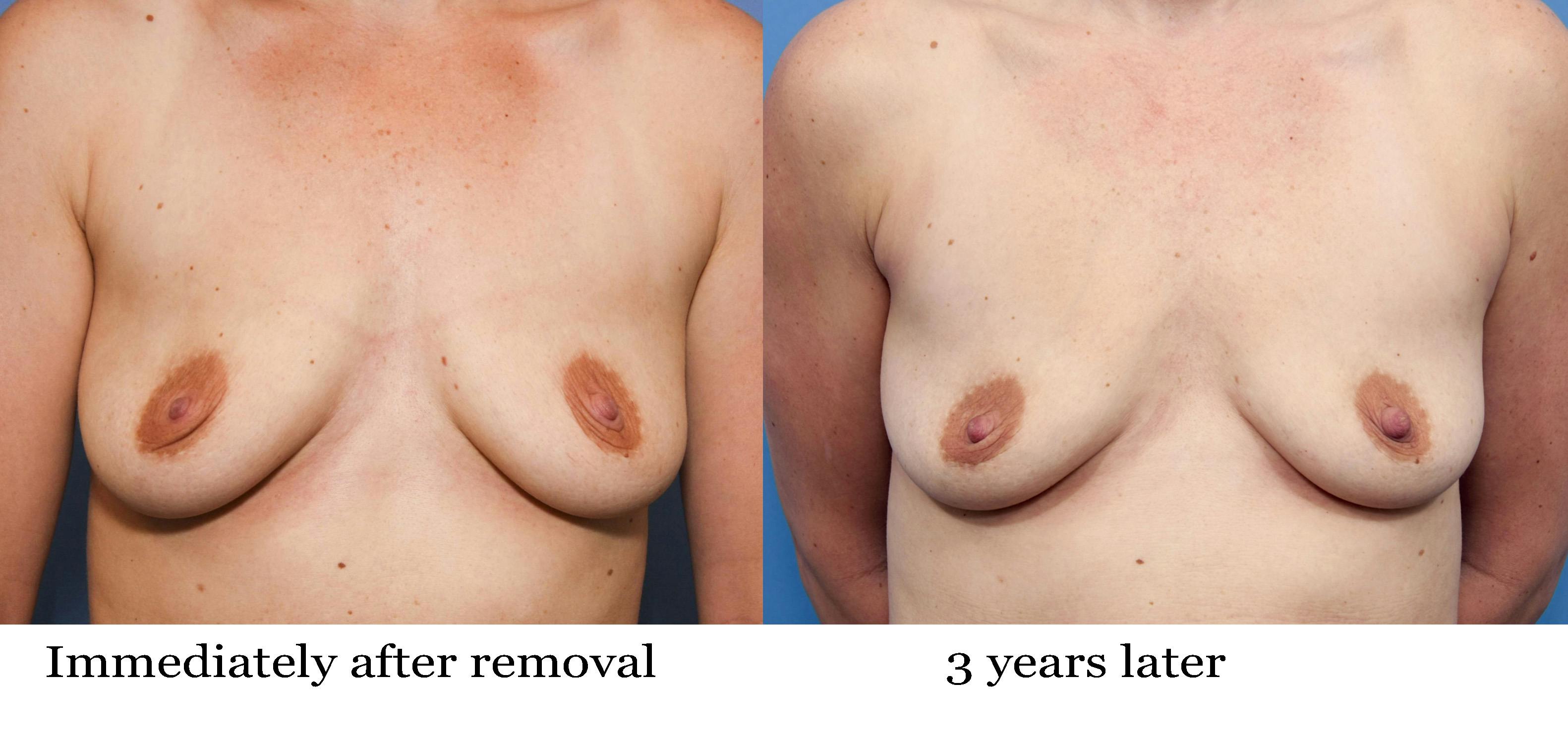 Breast Implant Removal Before & After Gallery - Patient 179961 - Image 2