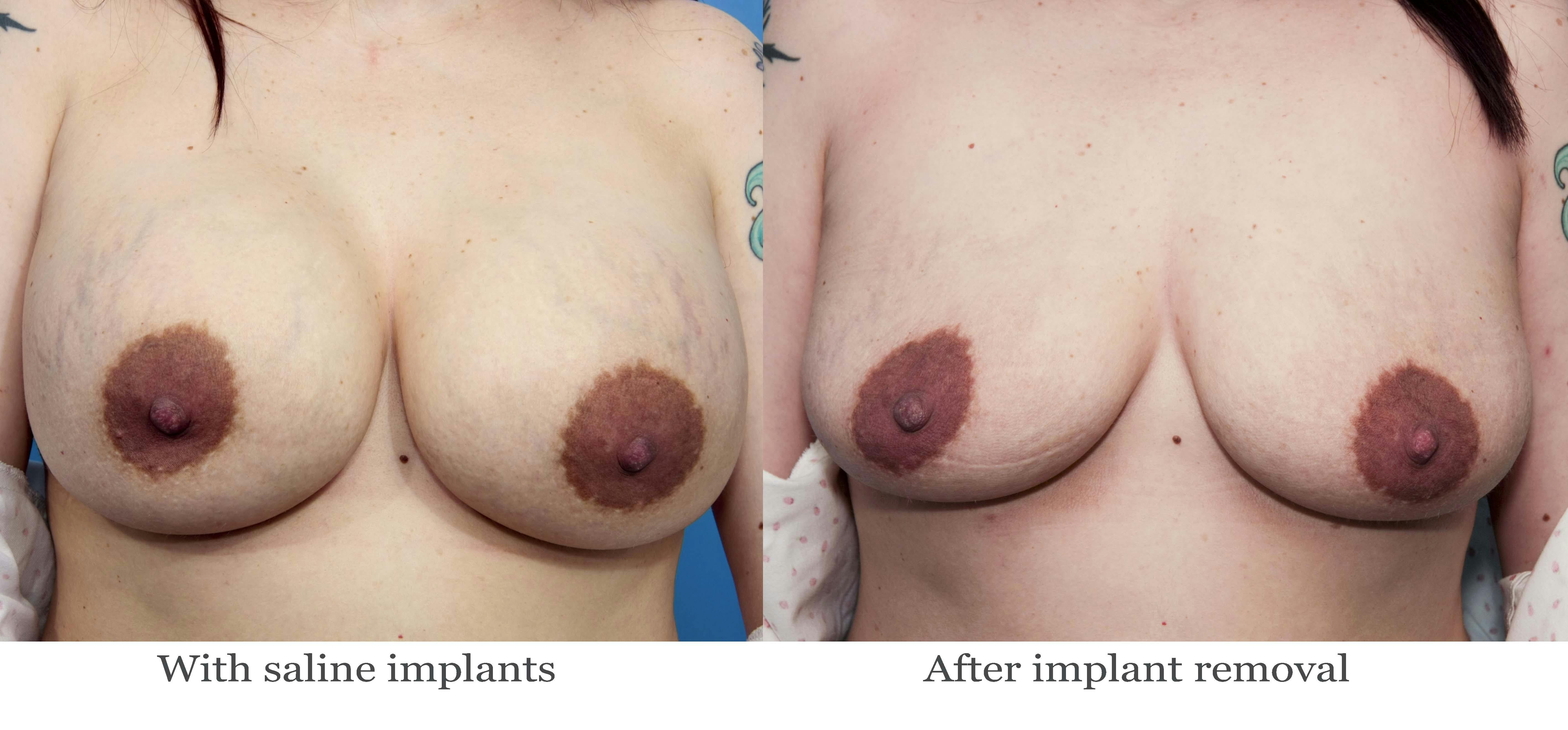 Breast Implant Removal Before & After Gallery - Patient 134237 - Image 1