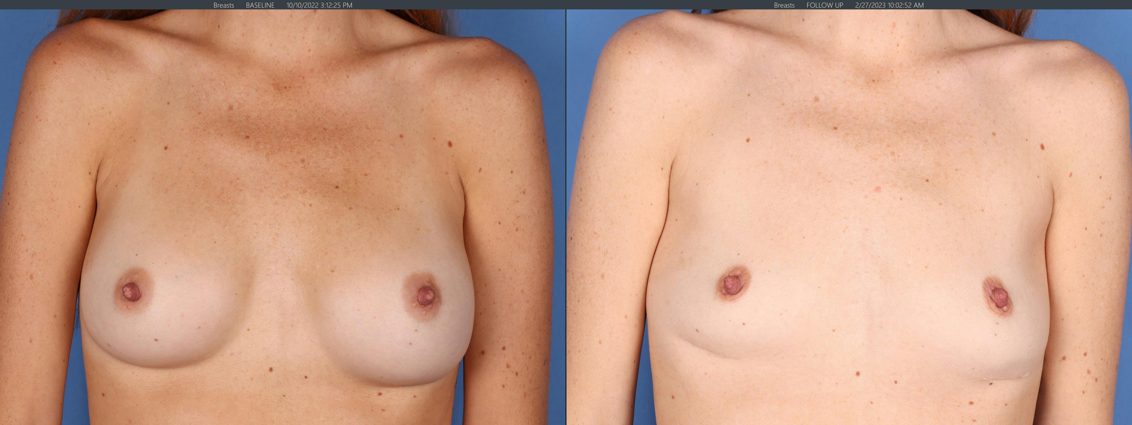 Breast Implant Removal Before & After Gallery - Patient 296770 - Image 1