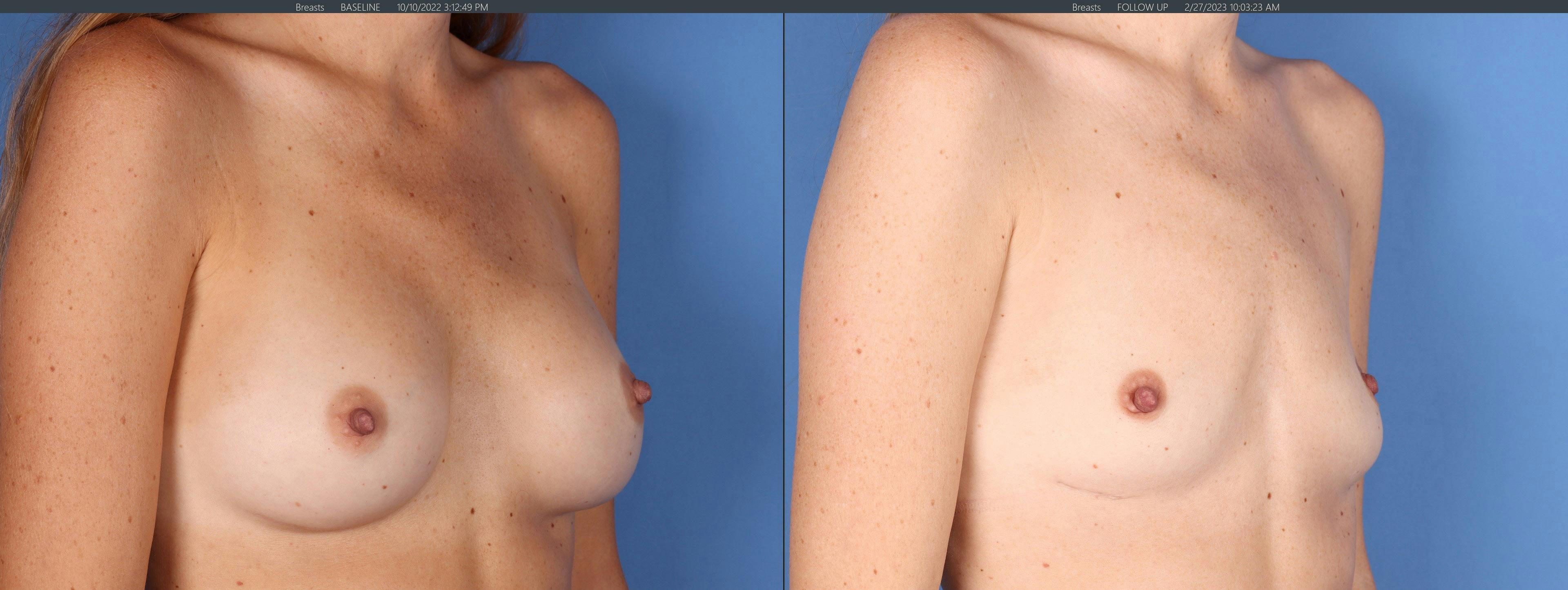 Breast Implant Removal Before & After Gallery - Patient 296770 - Image 2