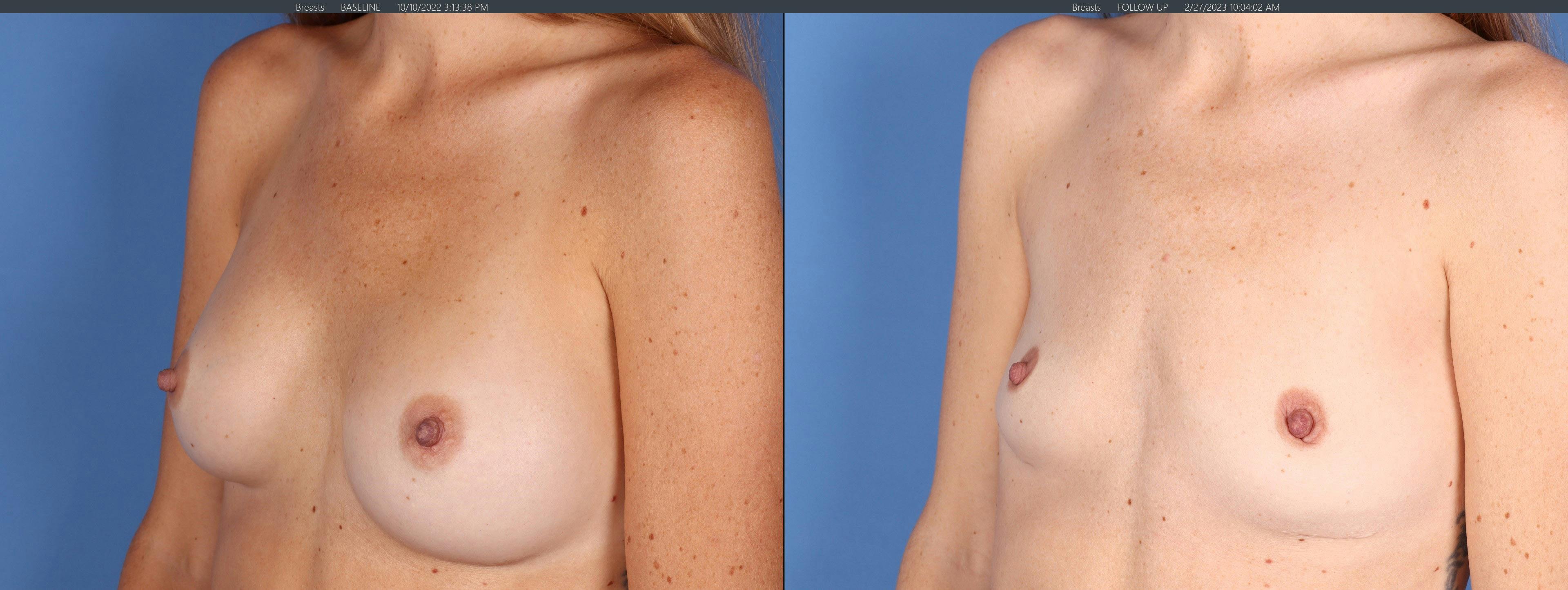Breast Implant Removal Before & After Gallery - Patient 296770 - Image 3