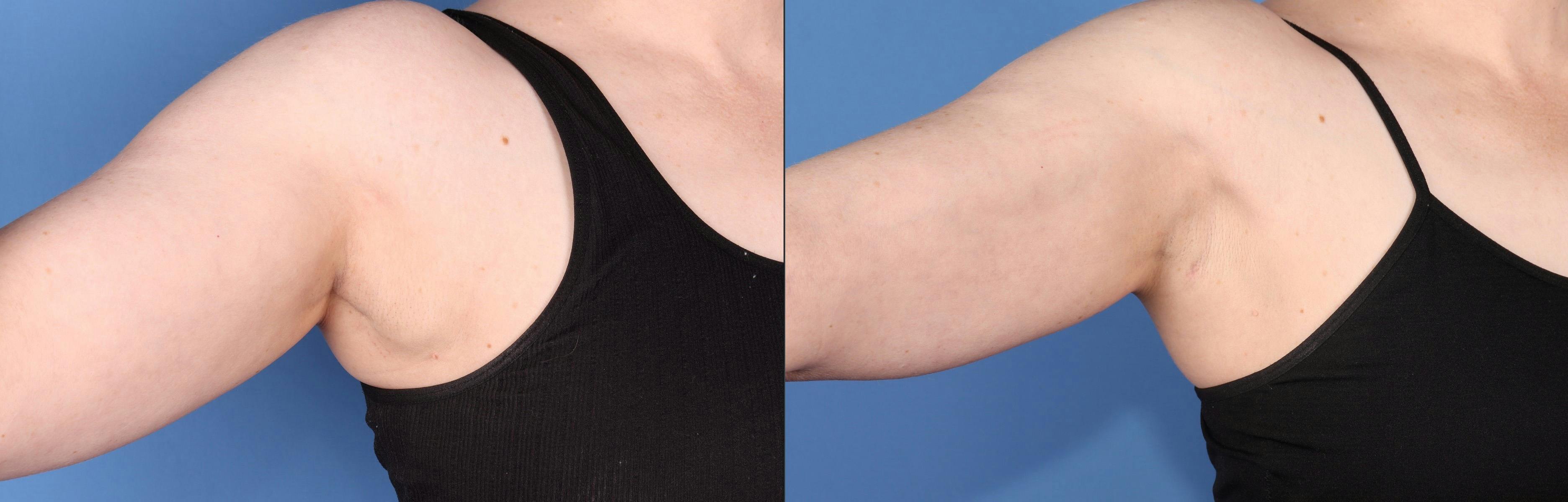Arms Before & After Gallery - Patient 427674 - Image 1