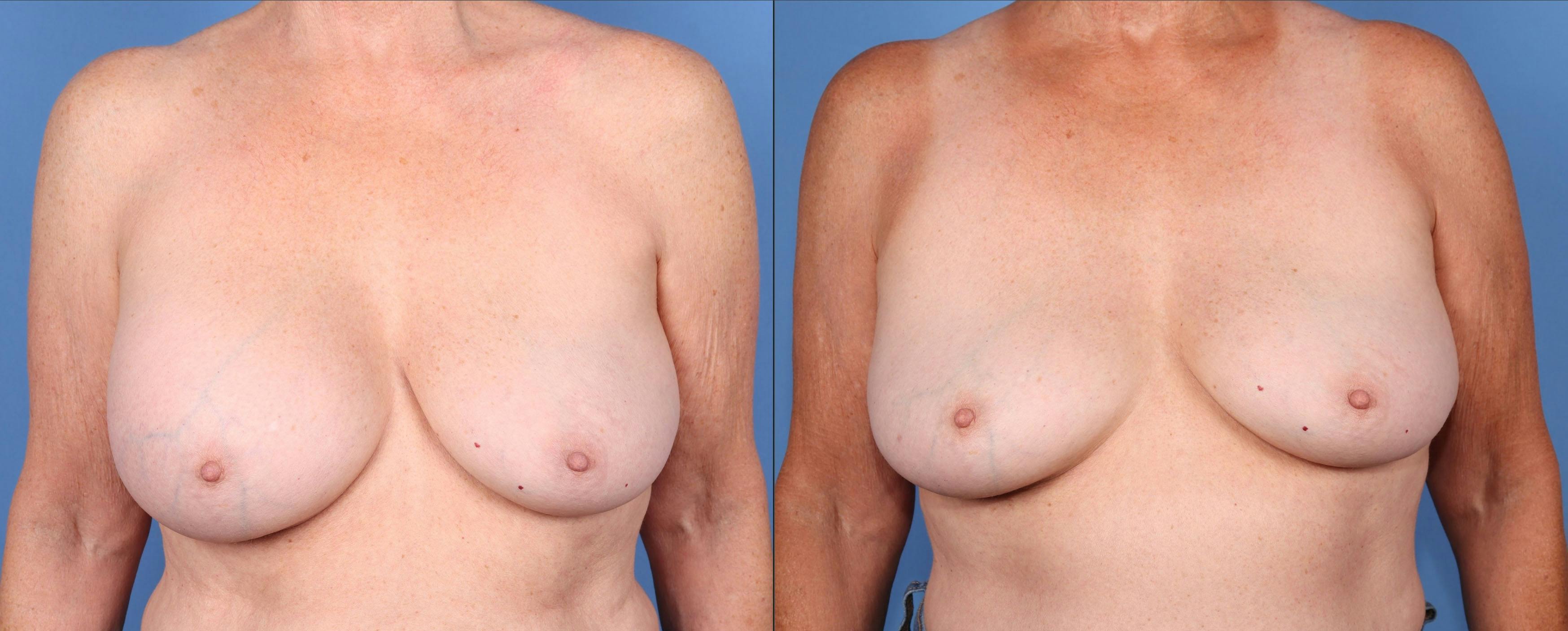 Breast Implant Removal Before & After Gallery - Patient 313481 - Image 1