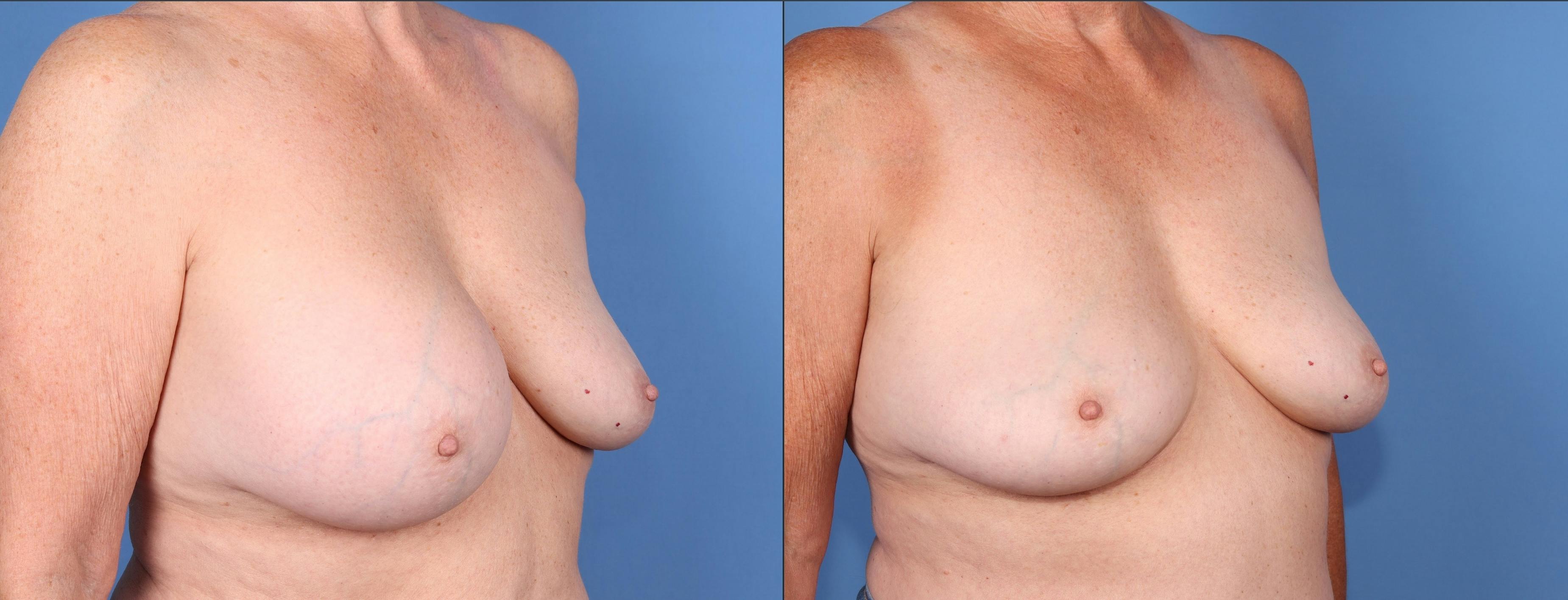 Breast Implant Removal Before & After Gallery - Patient 313481 - Image 2