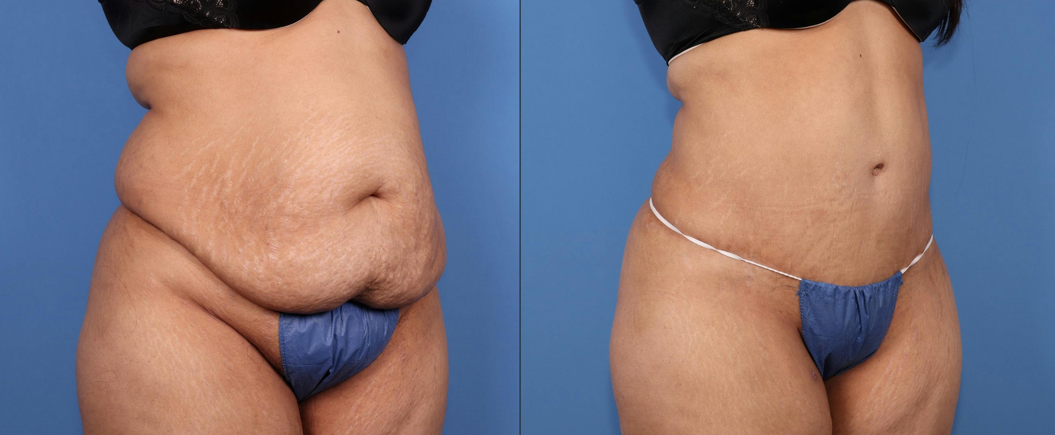 Abdomen Before & After Gallery - Patient 128562 - Image 2