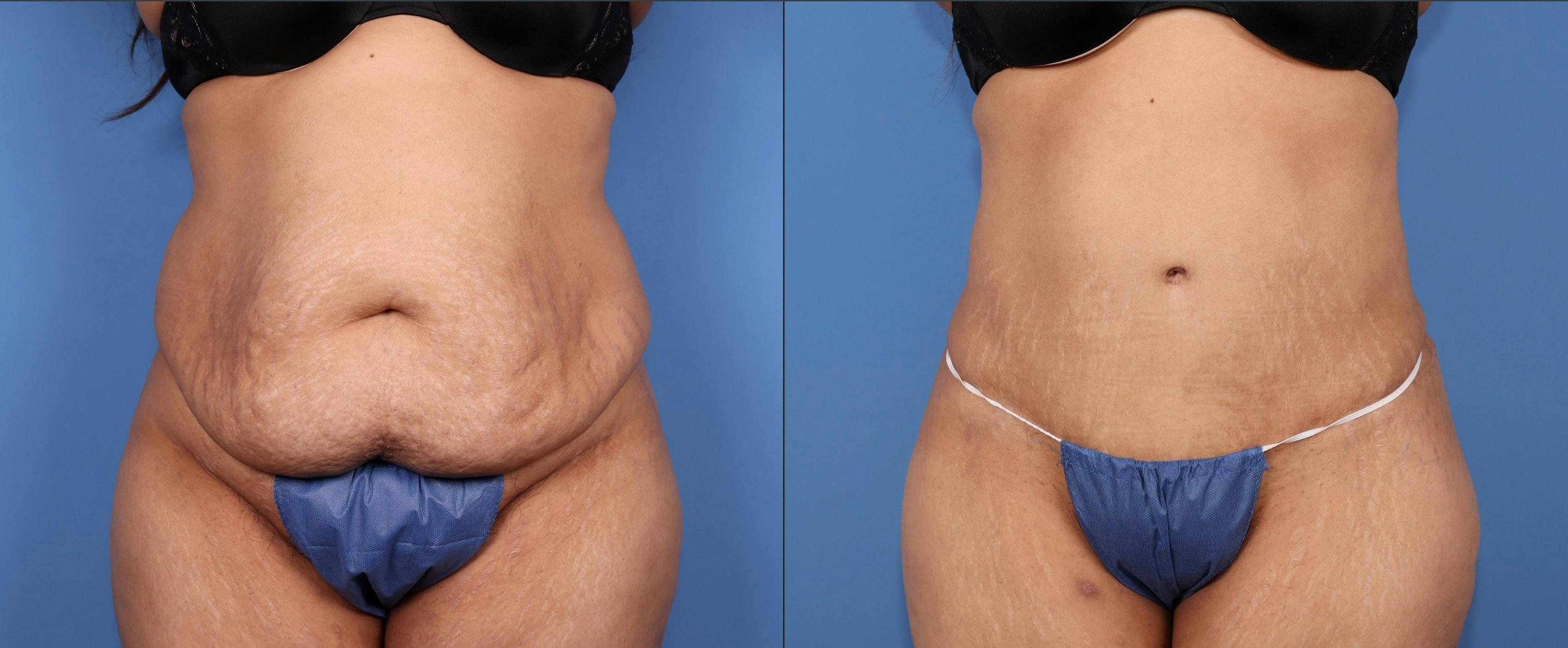 Abdomen Before & After Gallery - Patient 128562 - Image 1