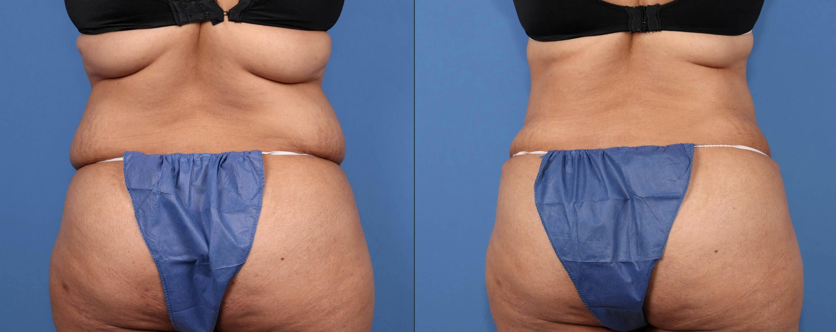 Abdomen Before & After Gallery - Patient 128562 - Image 4