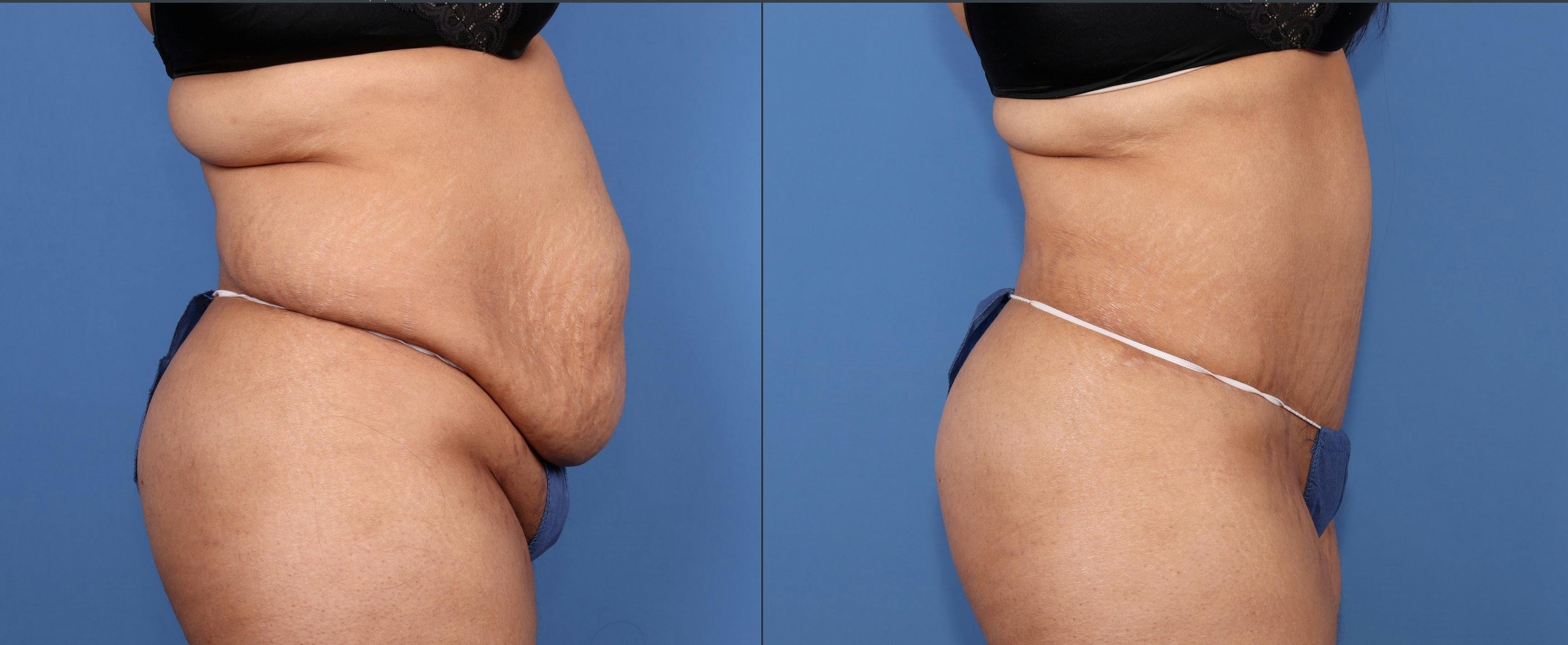 Abdomen Before & After Gallery - Patient 128562 - Image 3