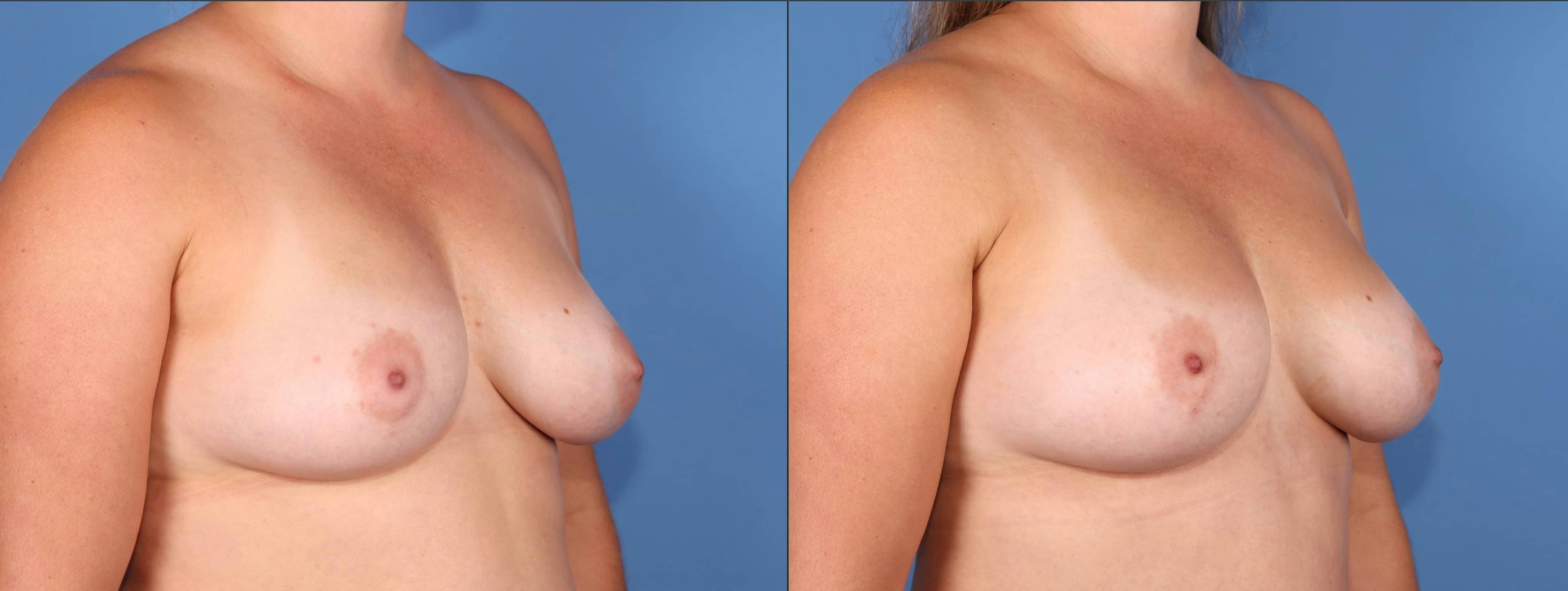 Fat Transfer Breast Augmentation Before & After Gallery - Patient 162007 - Image 2